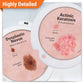 GPI Anatomicals Skin Cancer Model with Precancerous & Cancerous Skin Lesion