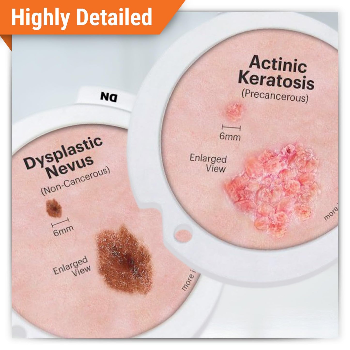 GPI Anatomicals Skin Cancer Model with Precancerous & Cancerous Skin Lesion