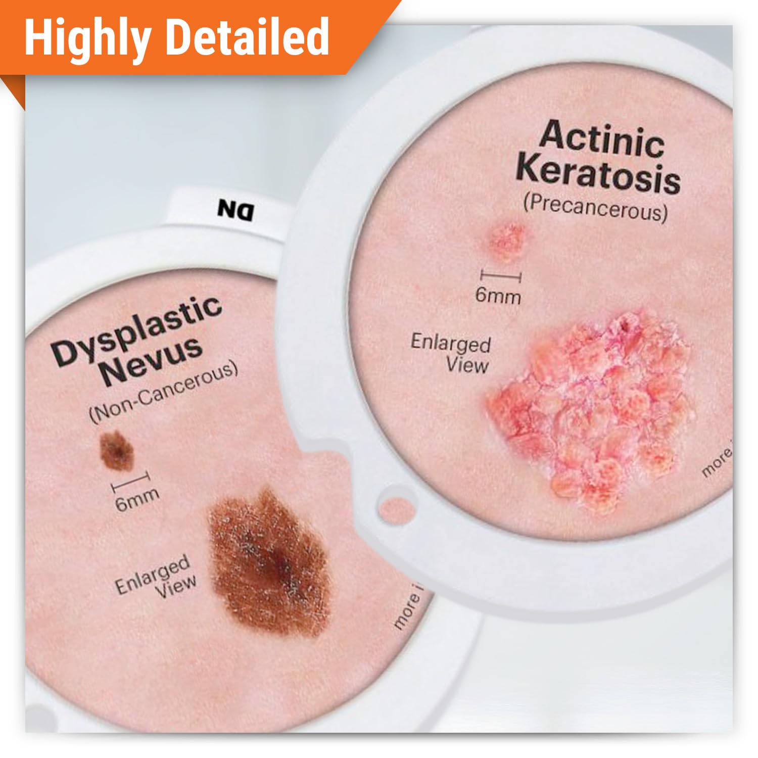 GPI Anatomicals Skin Cancer Model with Precancerous & Cancerous Skin Lesion
